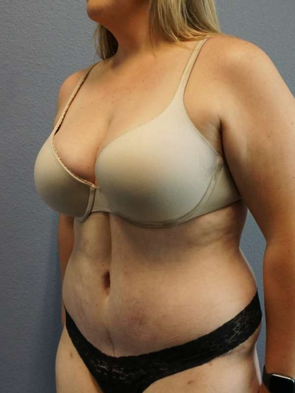 Abdominoplasty Before & After Patient #5197