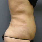 Liposuction Female Before & After Patient #7776