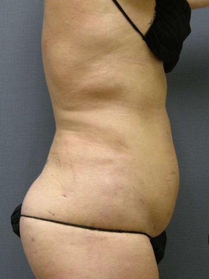 Liposuction Female Before & After Patient #7776