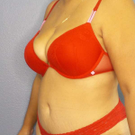 Abdominoplasty Before & After Patient #3638