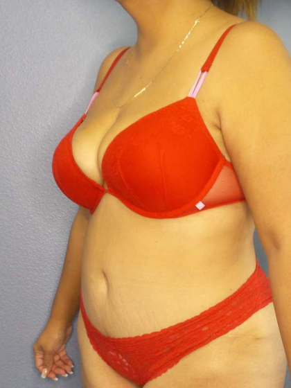 Abdominoplasty Before & After Patient #3638