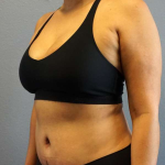 Abdominoplasty Before & After Patient #3583