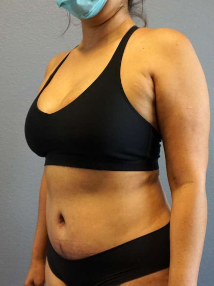Abdominoplasty Before & After Patient #3583