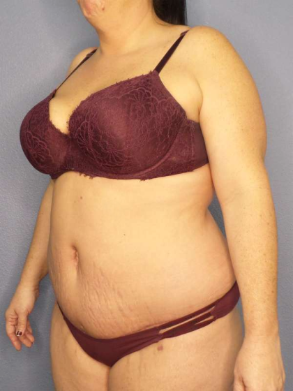 Abdominoplasty Before & After Patient #3572