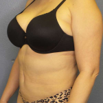 Liposuction Female Before & After Patient #7966