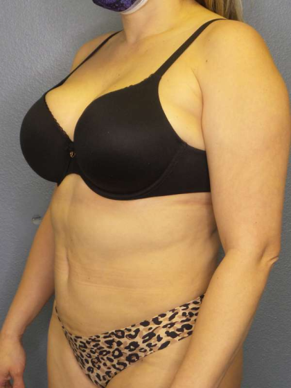 Liposuction Female Before & After Patient #7966