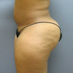 Brazilian Butt Lift Before & After Patient #4903
