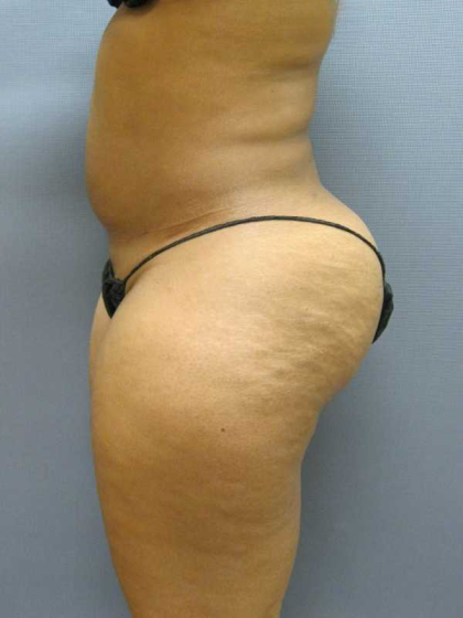 Brazilian Butt Lift Before & After Patient #4903