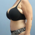 Abdominoplasty Before & After Patient #3786