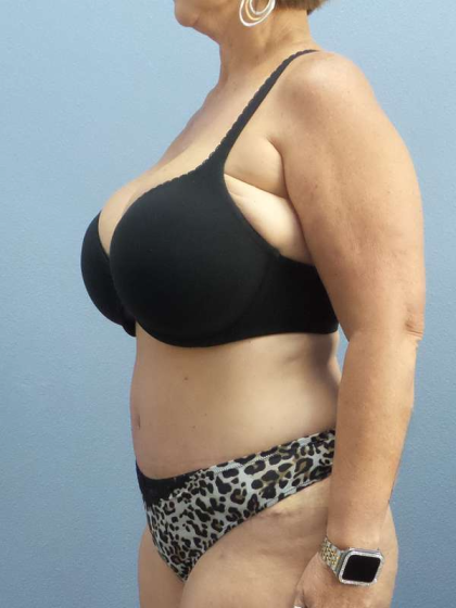 Abdominoplasty Before & After Patient #3786