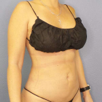 Liposuction Female Before & After Patient #8058