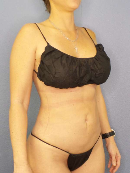Liposuction Female Before & After Patient #8058