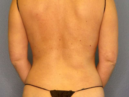 Liposuction Female Before & After Patient #7692