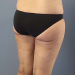 Liposuction Female Before & After Patient #7709