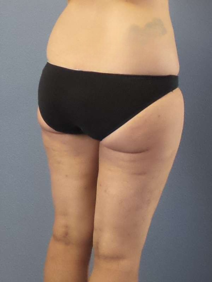 Liposuction Female Before & After Patient #7709
