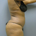 Liposuction Female Before & After Patient #7668