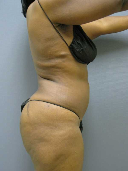 Liposuction Female Before & After Patient #7668