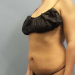 Abdominoplasty Before & After Patient #3775