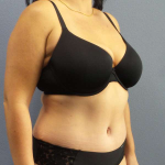 Abdominoplasty Before & After Patient #3550