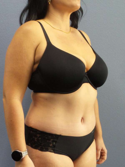 Abdominoplasty Before & After Patient #3550