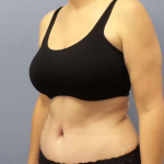 Abdominoplasty Before & After Patient #3471