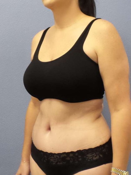 Abdominoplasty Before & After Patient #3471