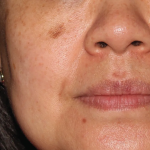 BroadBand Light (BBL™) Before & After Patient #13247