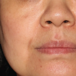 BroadBand Light (BBL™) Before & After Patient #13247