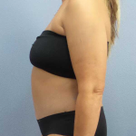 Abdominoplasty Before & After Patient #3594