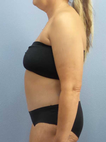 Abdominoplasty Before & After Patient #3594