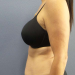 Abdominoplasty Before & After Patient #3471