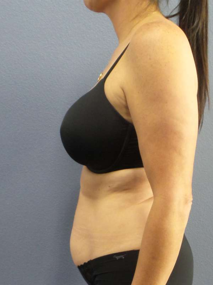 Abdominoplasty Before & After Patient #3471