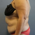 Abdominoplasty Before & After Patient #3437