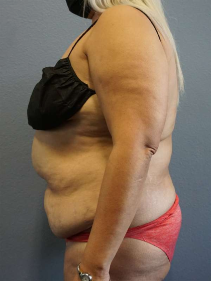 Abdominoplasty Before & After Patient #3437
