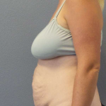 Abdominoplasty Before & After Patient #3409