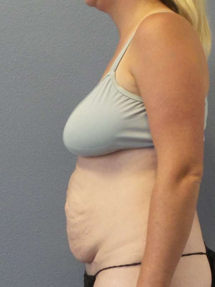 Abdominoplasty Before & After Patient #3409
