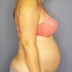 Abdominoplasty Before & After Patient #3350