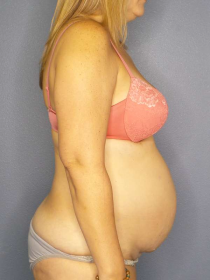 Abdominoplasty Before & After Patient #3350