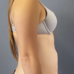 Abdominoplasty Before & After Patient #3236