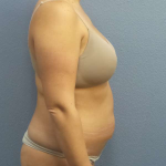 Abdominoplasty Before & After Patient #3225