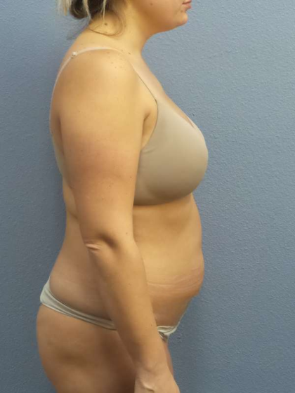 Abdominoplasty Before & After Patient #3225