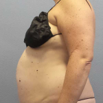 Liposuction Female Before & After Patient #11950