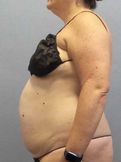 Liposuction Female Before & After Patient #11950