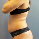 Liposuction Female Before & After Patient #11933