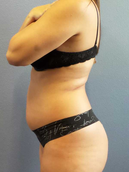 Liposuction Female Before & After Patient #11933