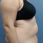Abdominoplasty Before & After Patient #11131