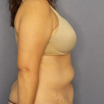Abdominoplasty Before & After Patient #3188