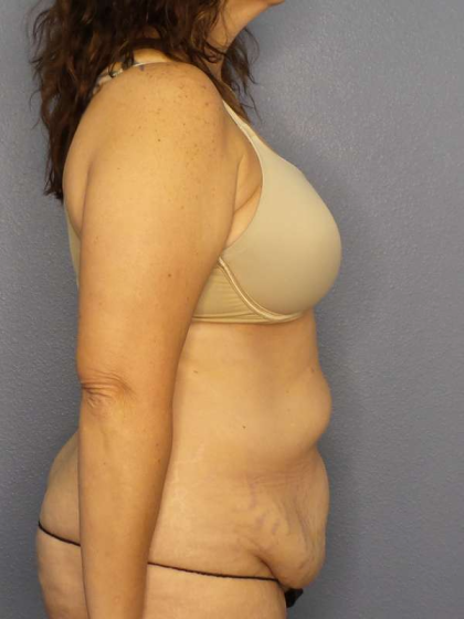 Abdominoplasty Before & After Patient #3188