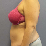 High BMI (Larger Patients) Surgery Before & After Patient #10378