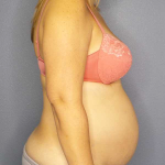 High BMI (Larger Patients) Surgery Before & After Patient #10329